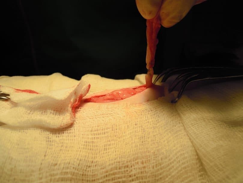 Gros plan de la chirurgie de la hernie ombilicale