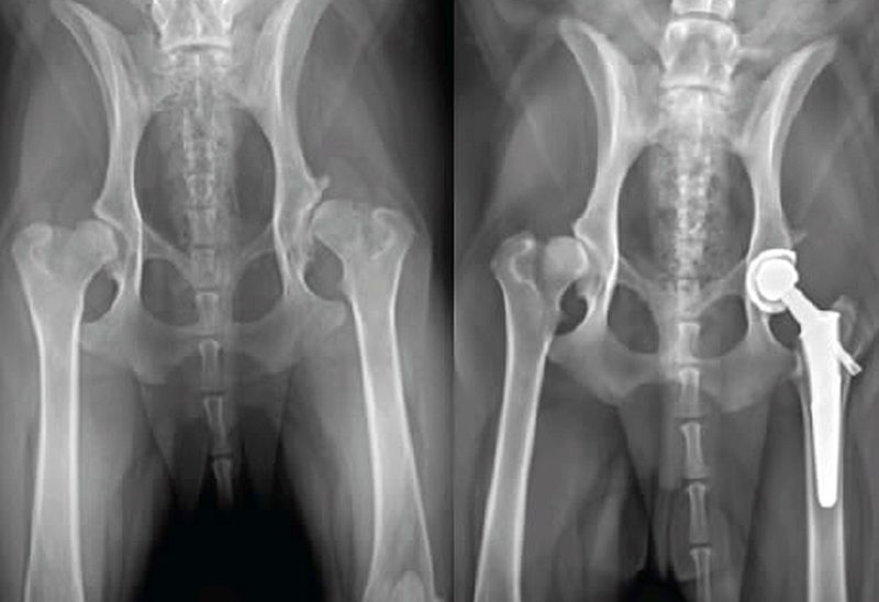 arthroplastie totale de la hanche