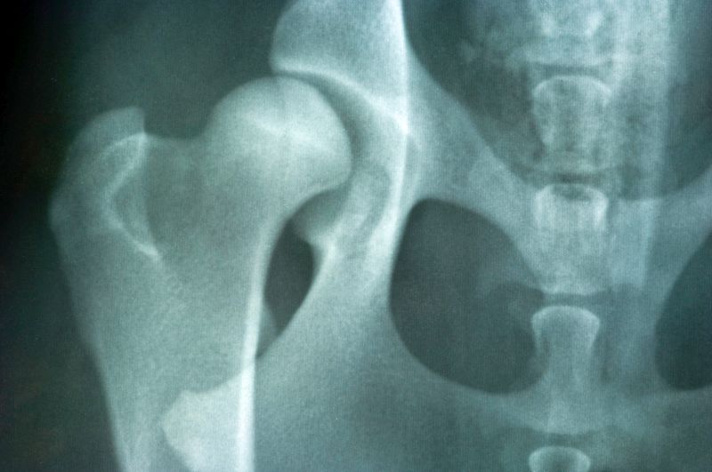 Radiographie de la dysplasie de la hanche